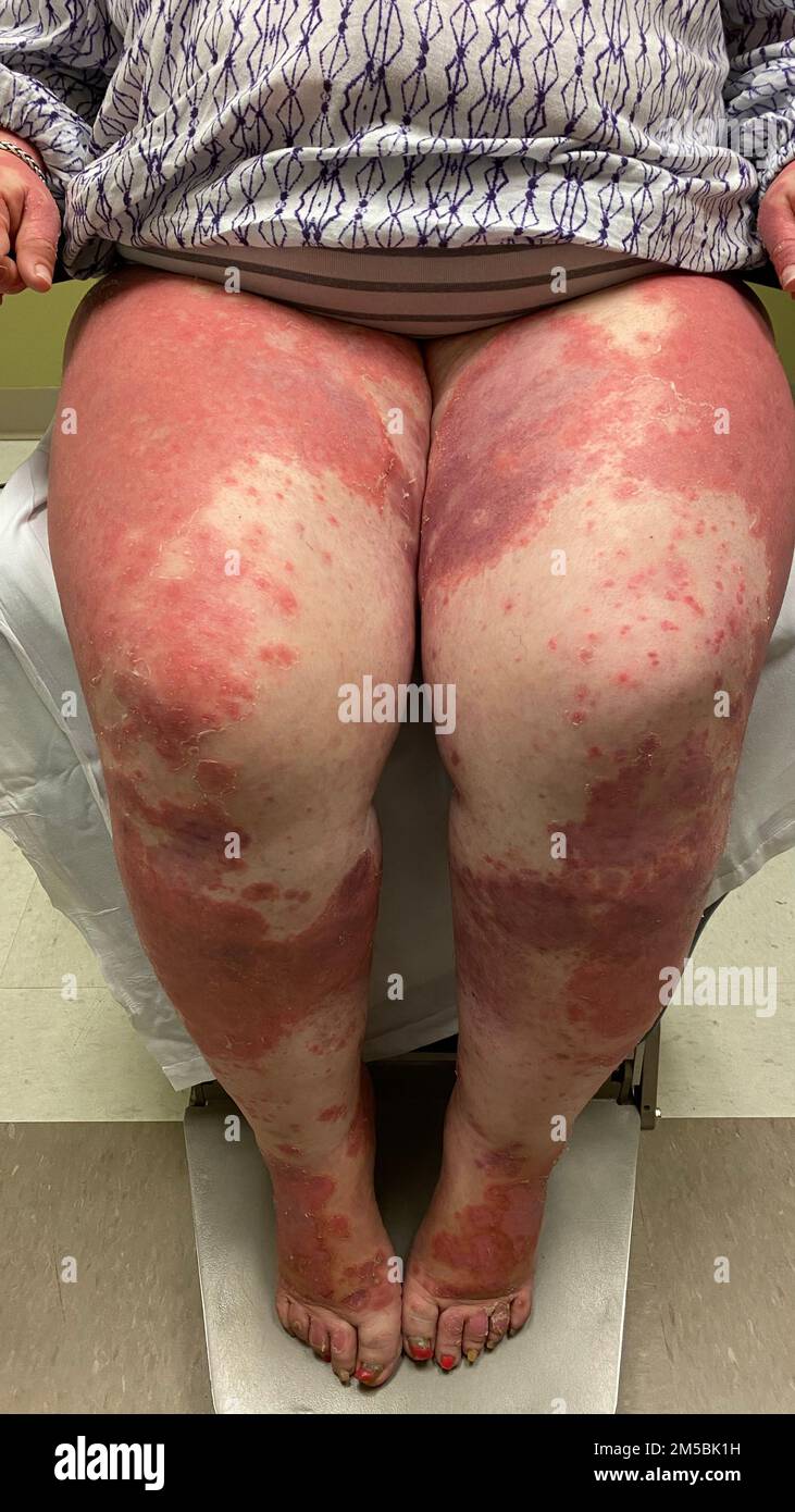 Ne pas utiliser pour la publicité ou dans un contexte diffamatoire psoriasis érythrodermique sur les jambes d'une patiente hispanique. Le psoriasis est un autoimmun Banque D'Images