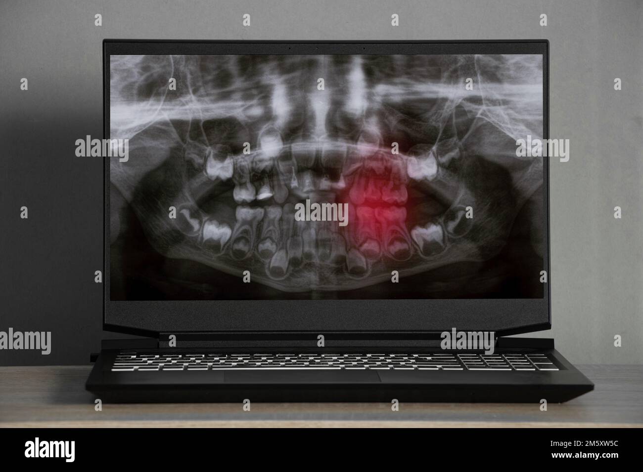 Radiographie panoramique des dents des enfants de deux mâchoires, orthopétomogramme des dents des enfants sur les écrans d'ordinateur portable sur la table Banque D'Images
