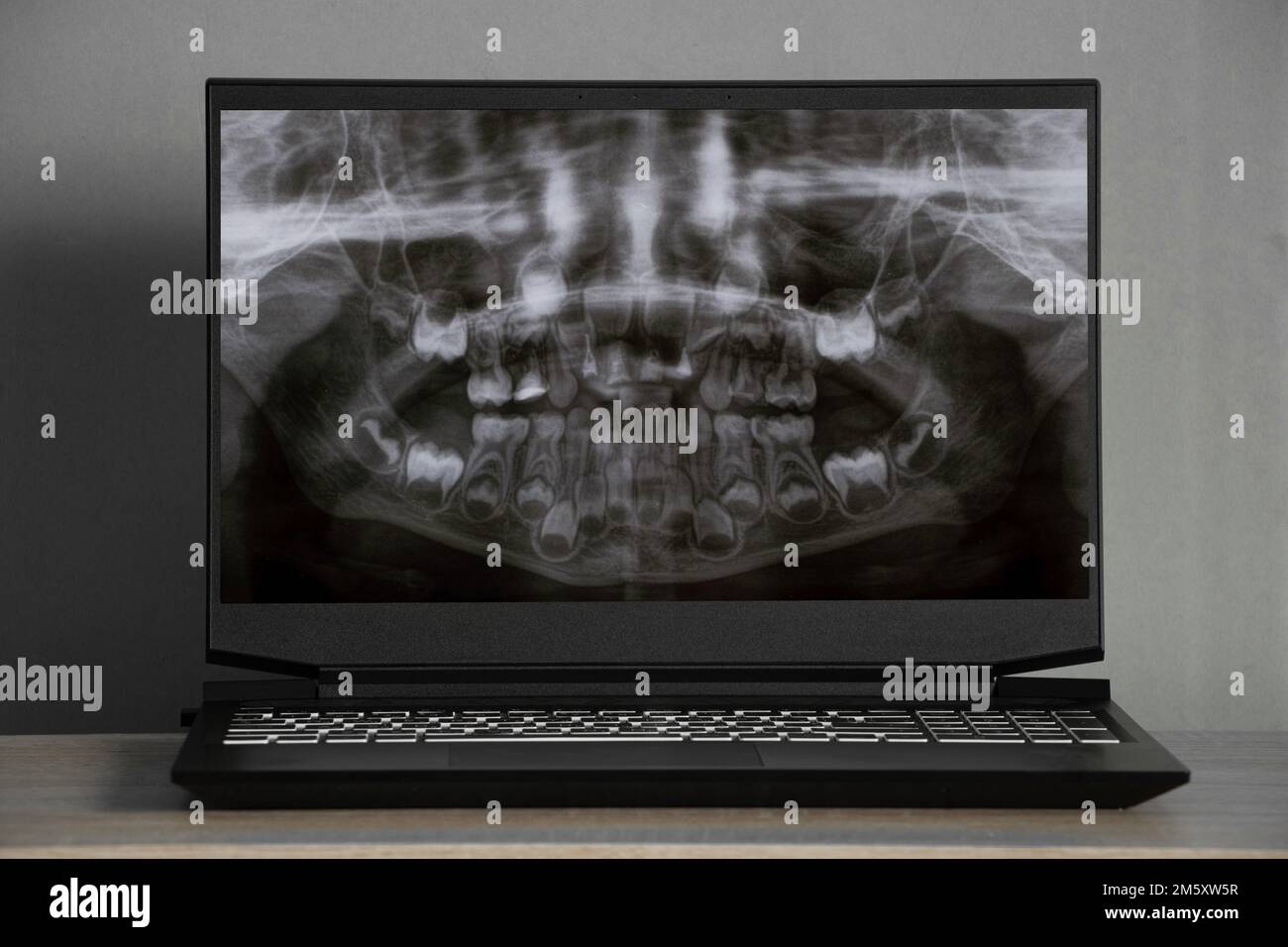Radiographie panoramique des dents des enfants de deux mâchoires, orthopétomogramme des dents des enfants sur les écrans d'ordinateur portable sur la table Banque D'Images