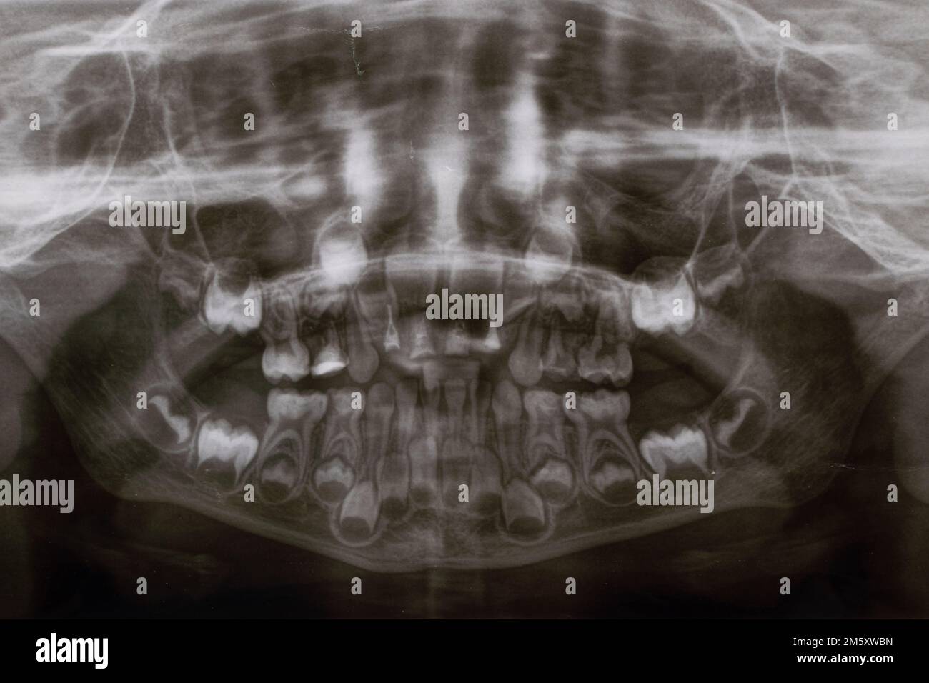 Une radiographie panoramique montre plusieurs dents incrustées et affectées sur la mâchoire supérieure et inférieure des dents des enfants Banque D'Images