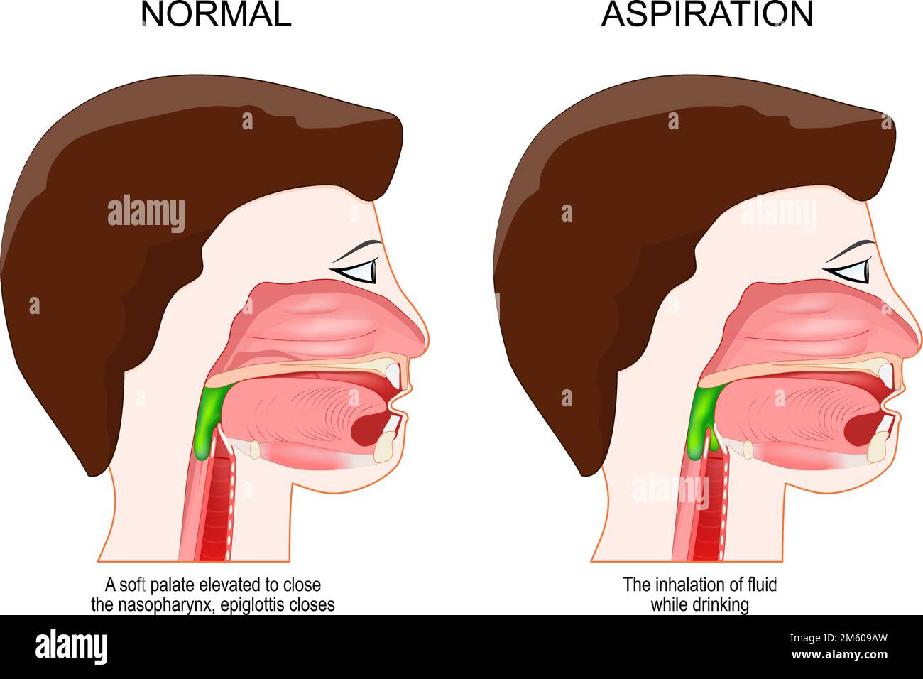 Dysphagie ou aspiration. diagnostic médical. Coupe transversale d'une tête humaine. Personne en bonne santé lorsqu'un palais mou est élevé pour fermer le nasopharynx Illustration de Vecteur