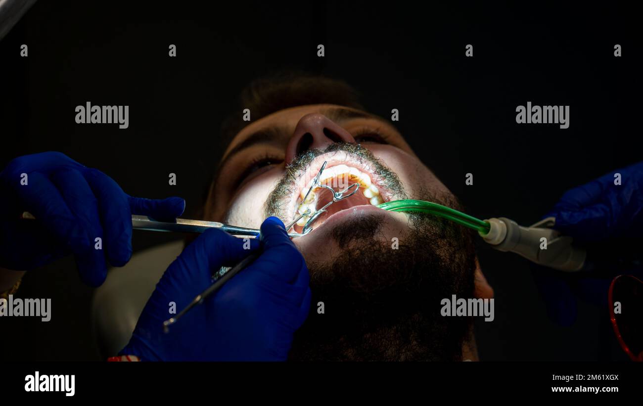 Prévention de la carie dentaire. homme dans la chaise de dentiste pendant une procédure dentaire. Sourire relooking. Banque D'Images