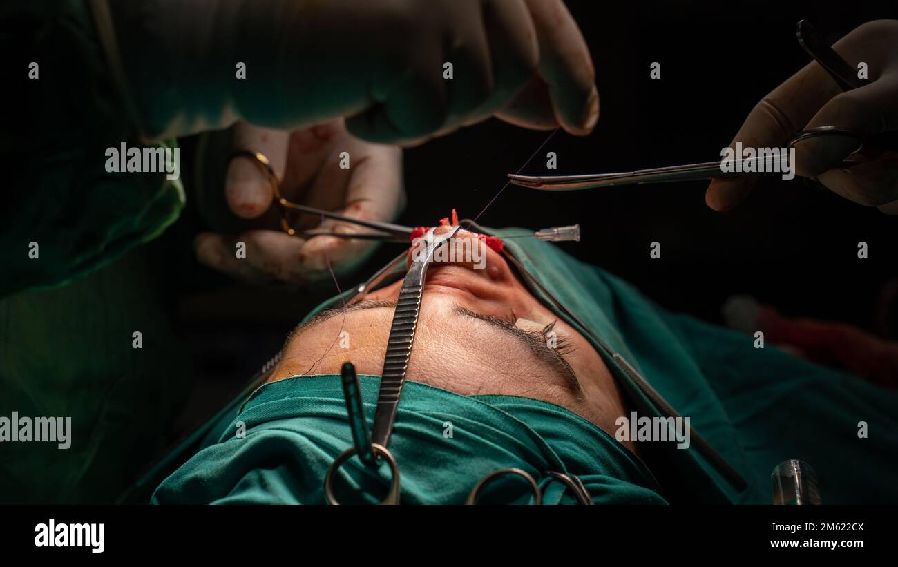 chirurgie de rhinoplastie, défauts dans la forme du nez chez la patiente. Intervention chirurgicale en chirurgie plastique rhinoplastie Banque D'Images