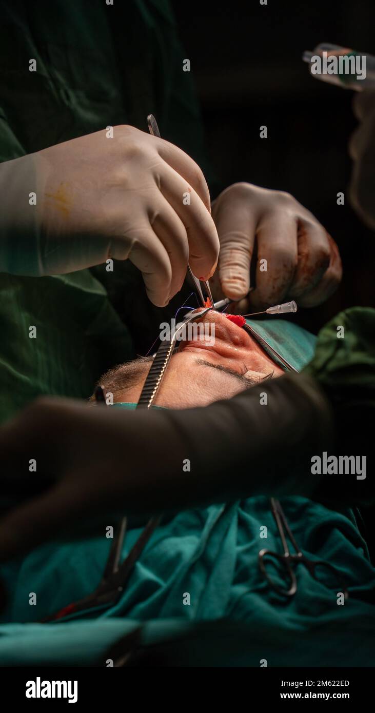 chirurgie de rhinoplastie, défauts dans la forme du nez chez la patiente. Intervention chirurgicale en chirurgie plastique rhinoplastie Banque D'Images
