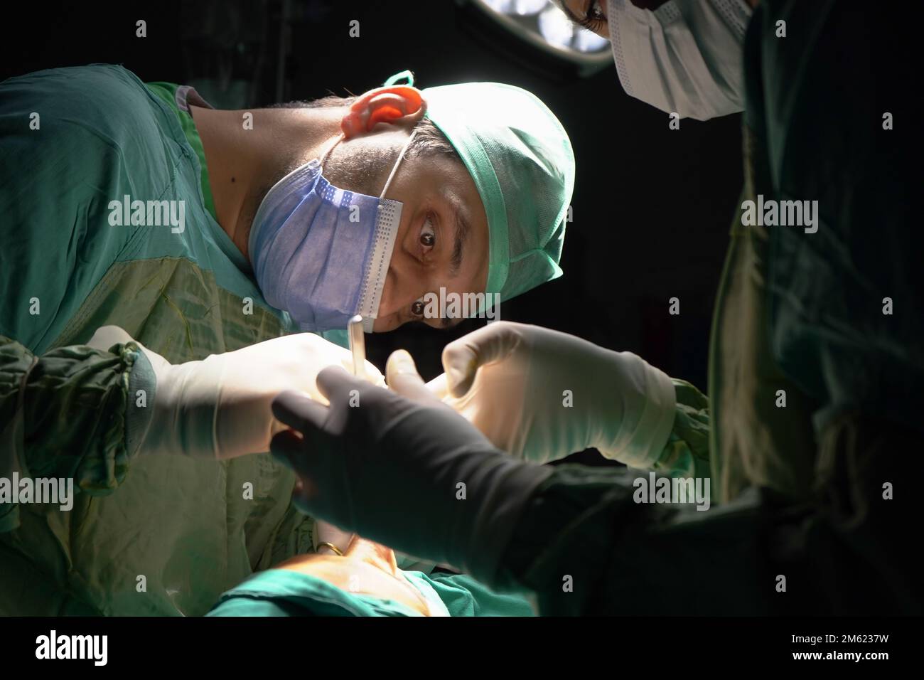 chirurgie de rhinoplastie, défauts dans la forme du nez chez la patiente. Intervention chirurgicale en chirurgie plastique rhinoplastie Banque D'Images