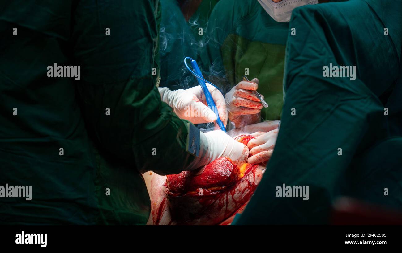 Chirurgien plastique effectuant une chirurgie mammaire dans la salle d'opération chirurgien plastique faisant un implant mammaire. Chirurgie d'augmentation et de réduction mammaire Banque D'Images