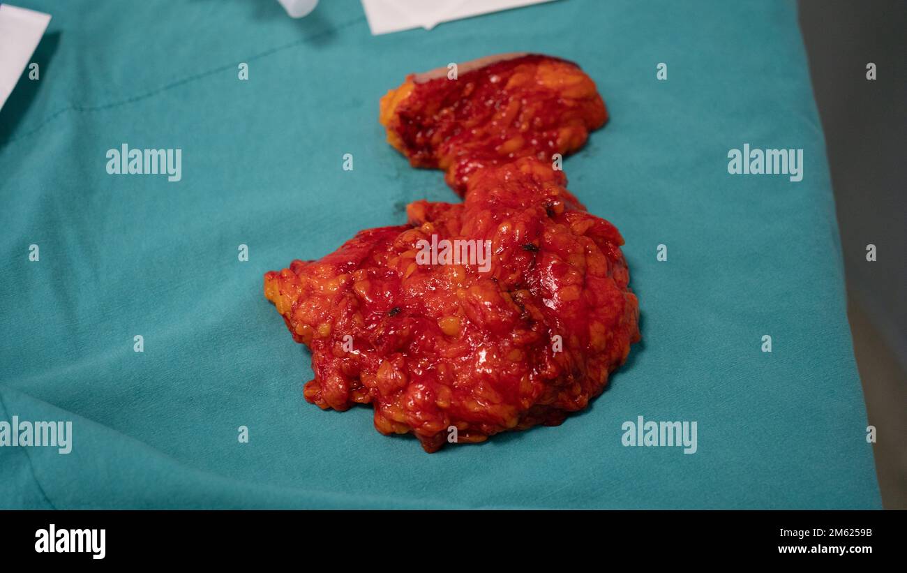 Chirurgien plastique effectuant une chirurgie mammaire dans la salle d'opération chirurgien plastique faisant un implant mammaire. Chirurgie d'augmentation et de réduction mammaire Banque D'Images