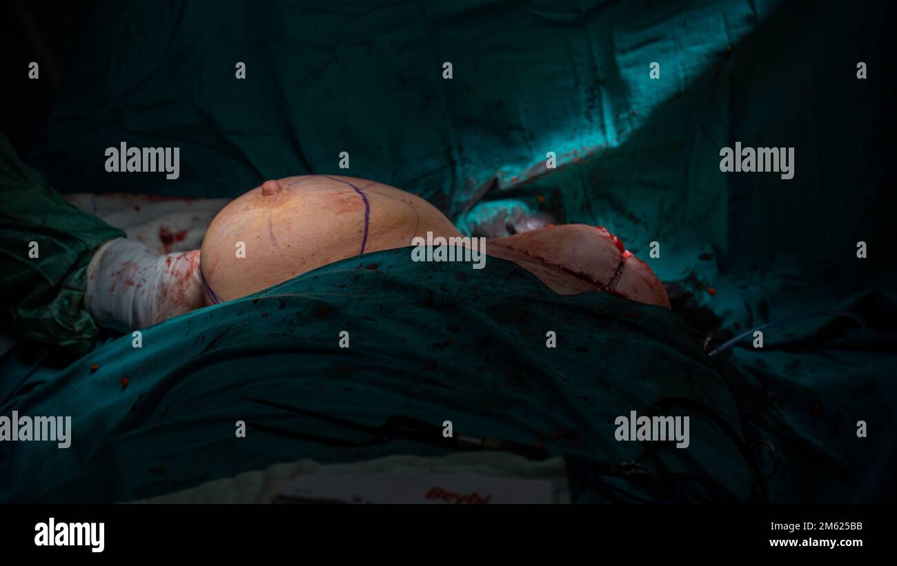 Chirurgien plastique effectuant une chirurgie mammaire dans la salle d'opération chirurgien plastique faisant un implant mammaire. Chirurgie d'augmentation et de réduction mammaire Banque D'Images