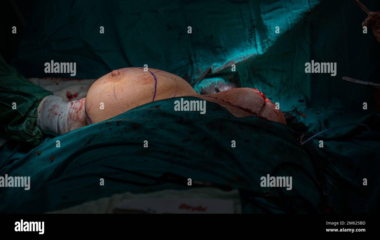 Chirurgien plastique effectuant une chirurgie mammaire dans la salle d'opération chirurgien plastique faisant un implant mammaire. Chirurgie d'augmentation et de réduction mammaire Banque D'Images