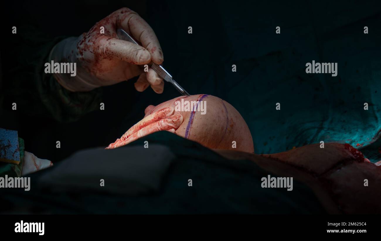 Chirurgien plastique effectuant une chirurgie mammaire dans la salle d'opération chirurgien plastique faisant un implant mammaire. Chirurgie d'augmentation et de réduction mammaire Banque D'Images