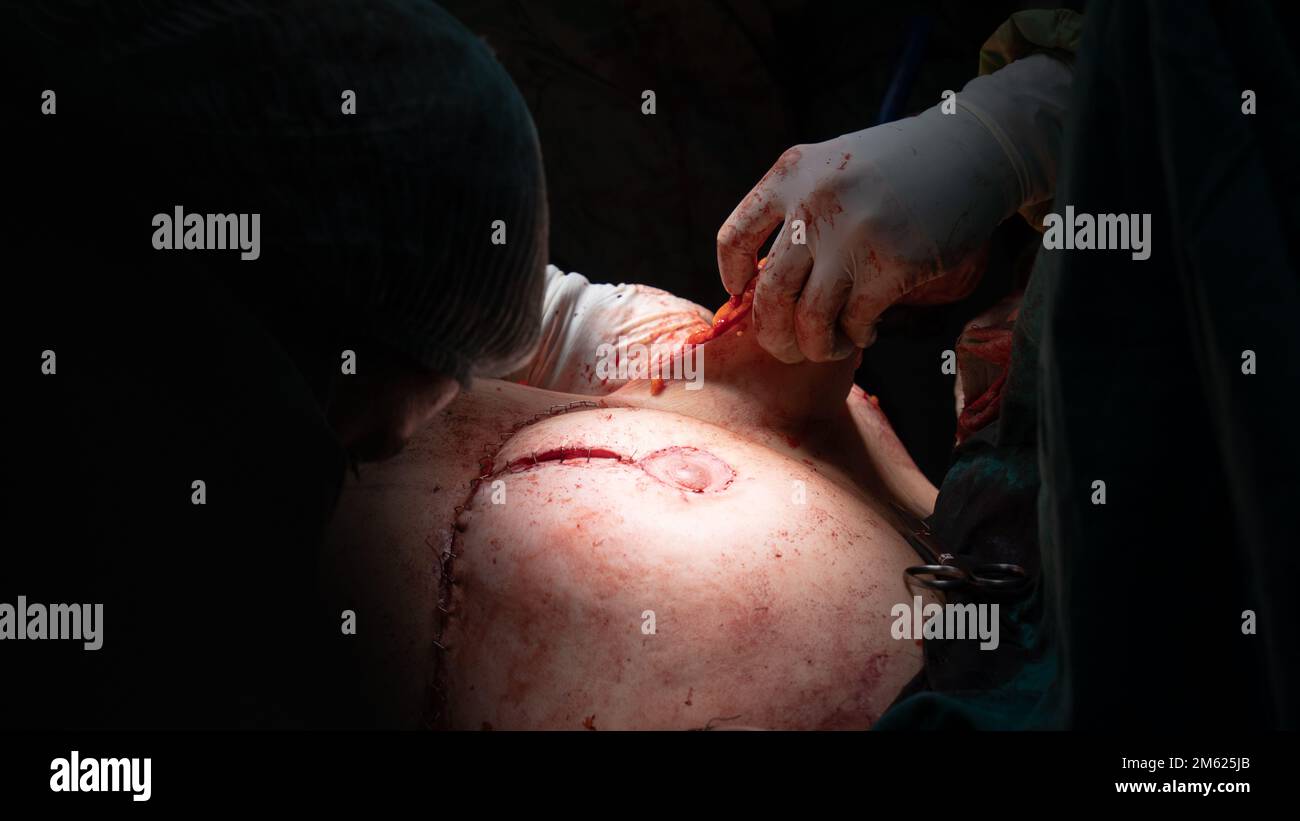 Chirurgien plastique effectuant une chirurgie mammaire dans la salle d'opération chirurgien plastique faisant un implant mammaire. Chirurgie d'augmentation et de réduction mammaire Banque D'Images
