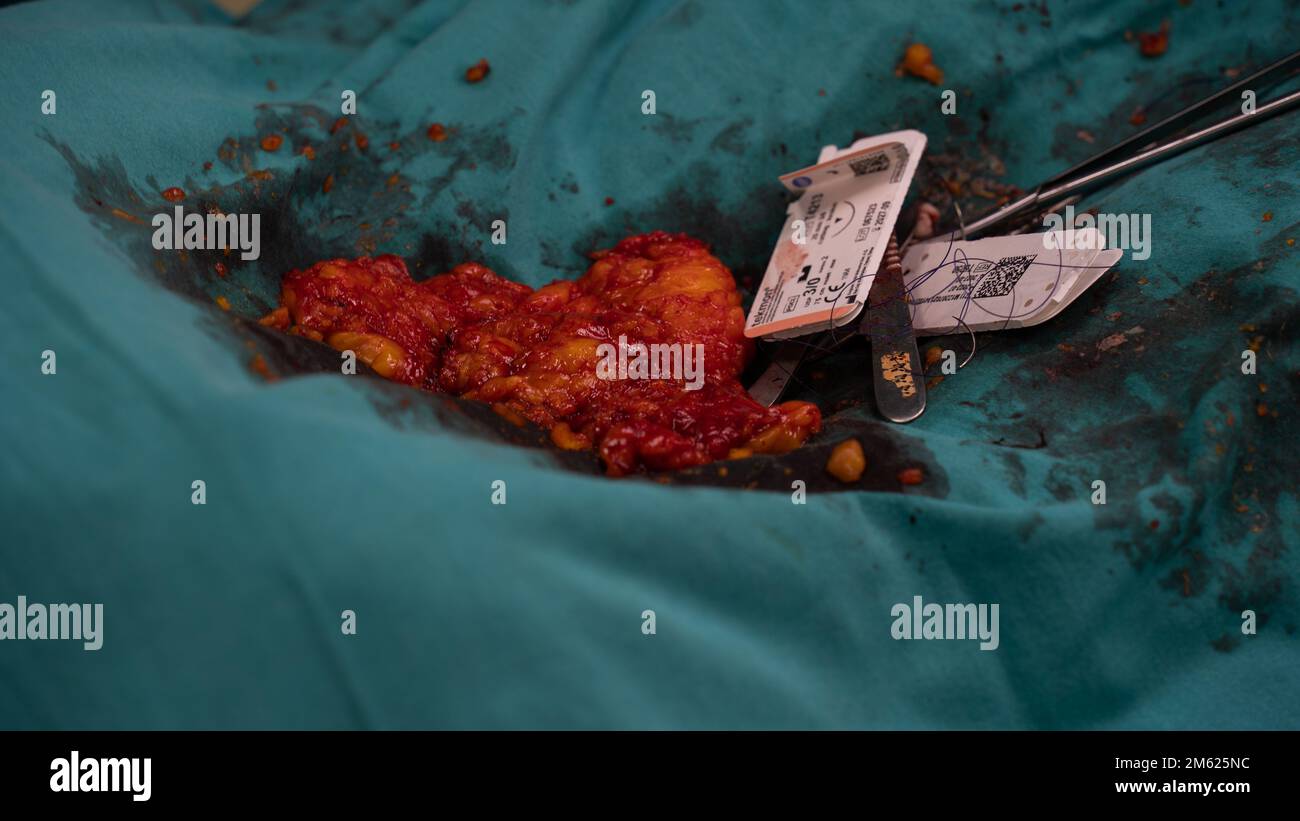 Chirurgien plastique effectuant une chirurgie mammaire dans la salle d'opération chirurgien plastique faisant un implant mammaire. Chirurgie d'augmentation et de réduction mammaire Banque D'Images