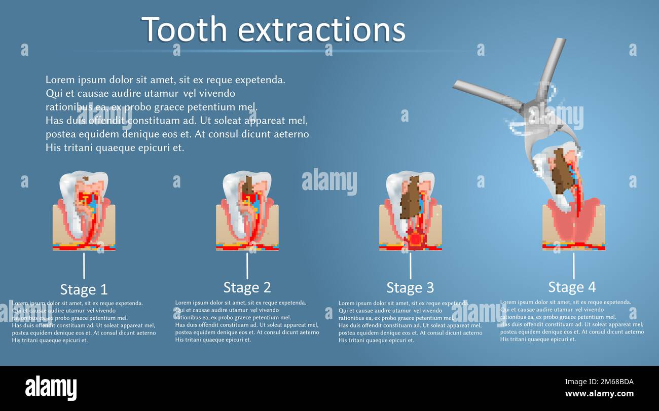 Modèle de bannière d'affiche vecteur de concept d'extraction de dent Illustration de Vecteur