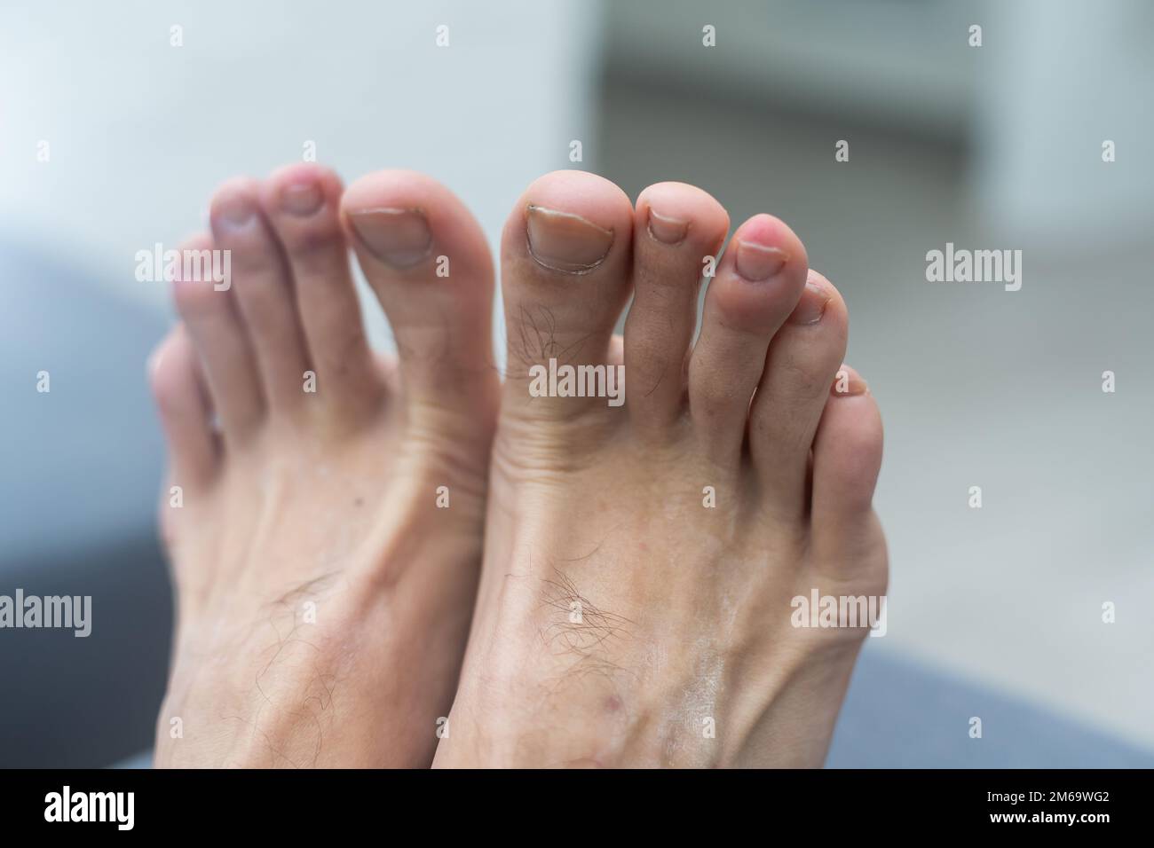 endommagé un gros ongle sur le pied mâle. Banque D'Images