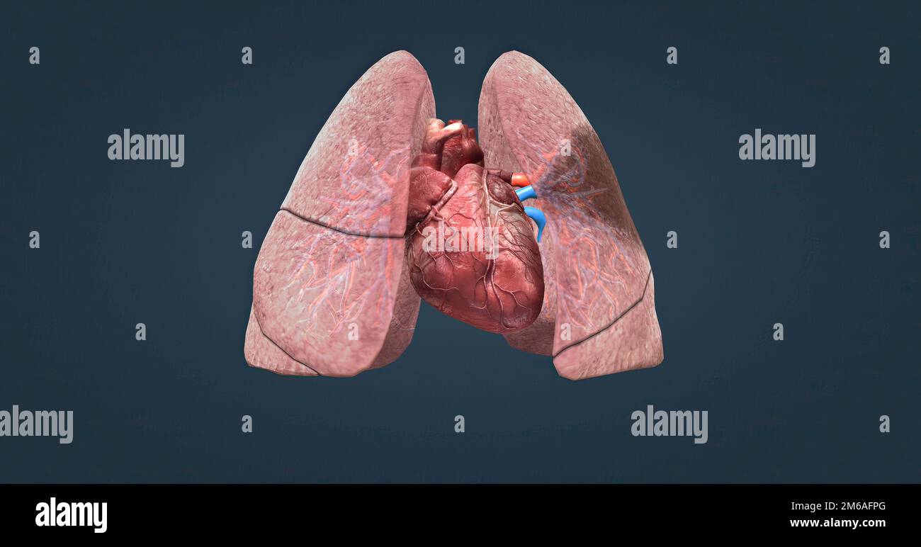 Une embolie pulmonaire (PE) se produit lorsqu