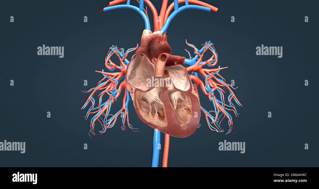 Une embolie pulmonaire (PE) se produit lorsqu