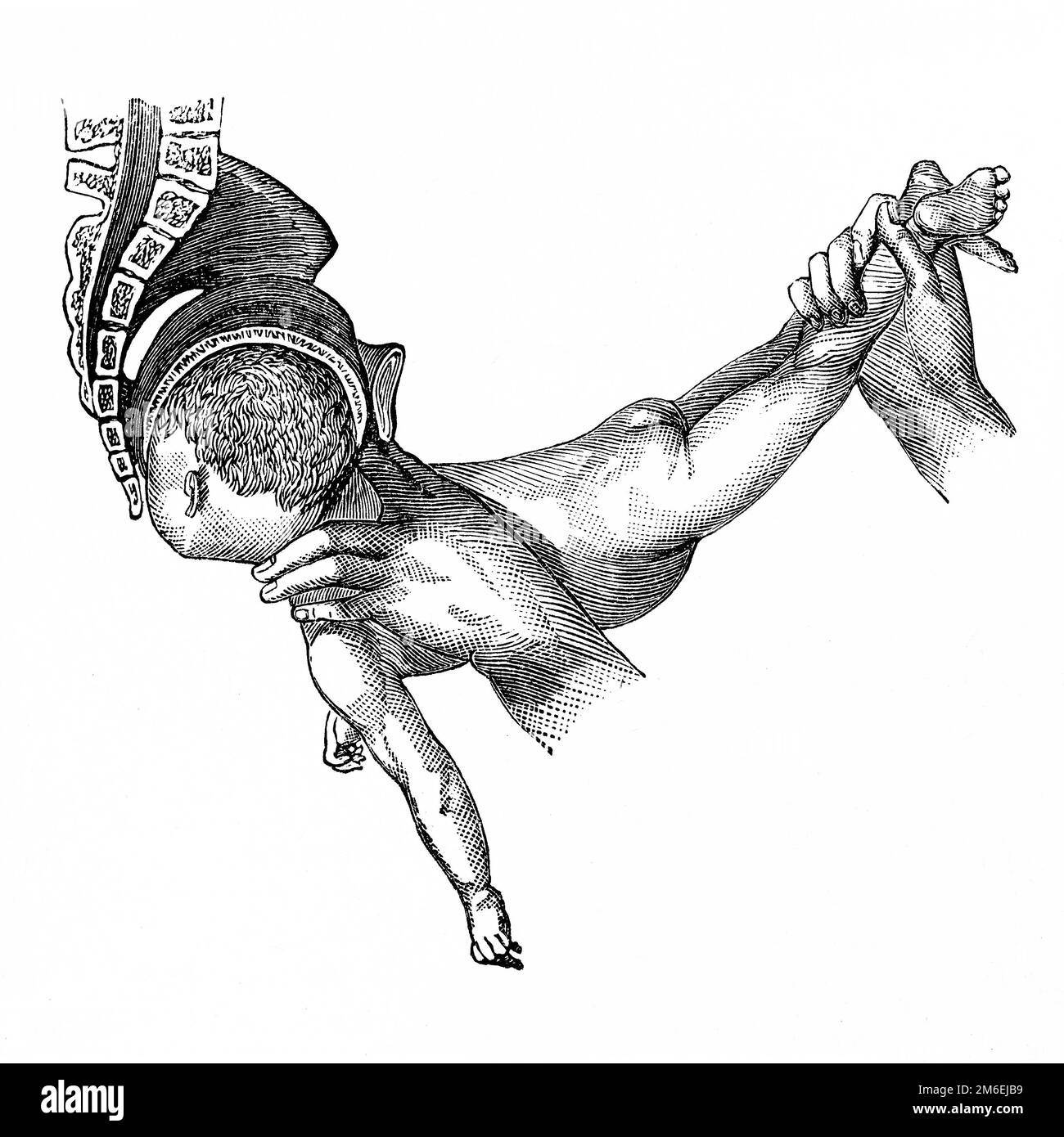 Aider la naissance. En sortant de la tête, le tronc du fœtus est élevé vers le plan abdominal de la mère pour faciliter l'accouchement. Illustration ancienne Banque D'Images