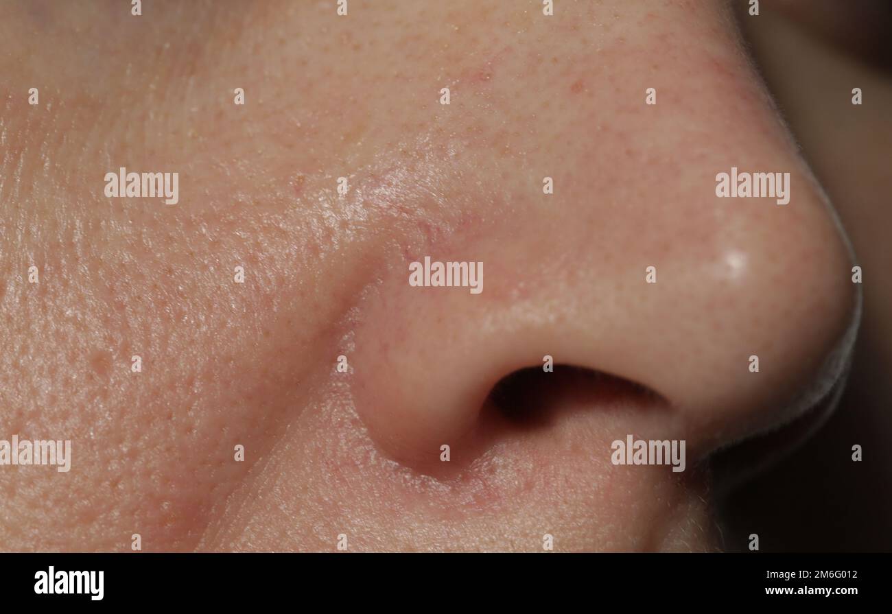 Gros plan extrême de la texture de la peau humaine problématique avec de grands pores ouverts, cicatrices d'acné et pli nasolabial Banque D'Images