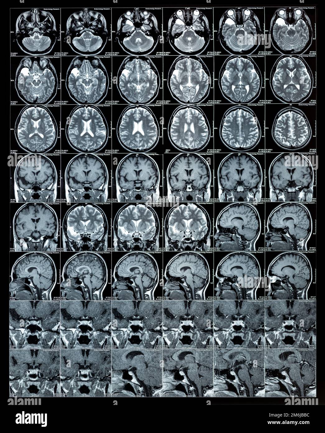 Résultats de l'IRM du cerveau ou de l'image par résonance magnétique, concept de neurologie Banque D'Images