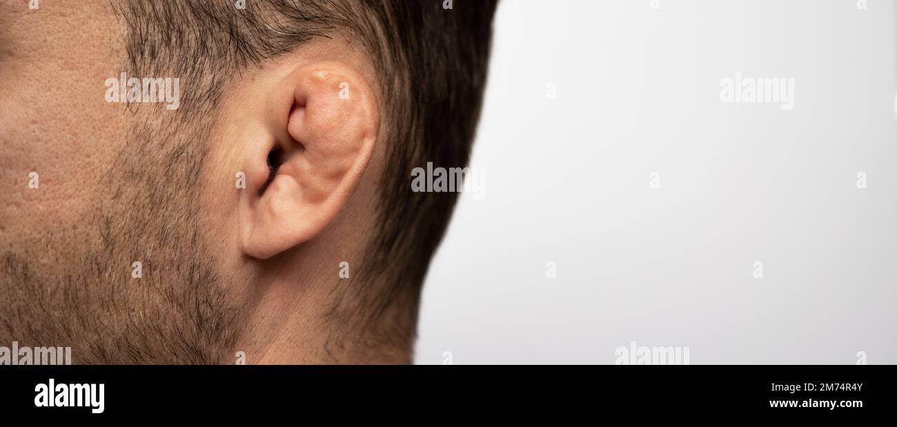 Photographie de la fracture de l'oreille du lutteur. Banque D'Images