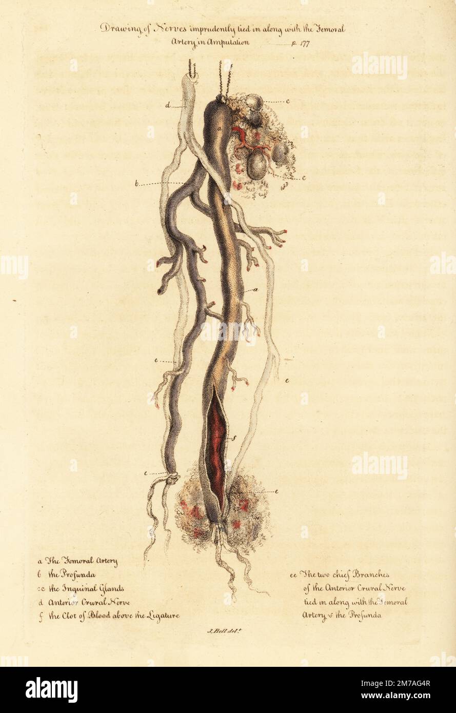 Exemple de la doctrine de Claude Pouteau de lier les nerfs aux artères en amputations. Dessin de nerfs imprudemment liés avec l'artère fémorale en amputation. Artère fémorale a, profunda b, glandes inguinales cc, nerf de la crerie antérieure d, deux branches principales du nerf de la crerie antérieure liées dans l'EE, Et un caillot de sang au-dessus de la ligature F. gravure de coperplate de couleur main après une illustration de John Bell de ses propres principes de chirurgie, comme ils se rapportent aux blessures, ulcères et fistules, Longman, Hurst, Rees, Orme et Brown, Londres, 1815. Banque D'Images Exemple de la doctrine de Claude Pouteau de lier les nerfs aux artères en amputations. Dessin de nerfs imprudemment liés avec l'artère fémorale en amputation. Artère fémorale a, profunda b, glandes inguinales cc, nerf de la crerie antérieure d, deux branches principales du nerf de la crerie antérieure liées dans l'EE, Et un caillot de sang au-dessus de la ligature F. gravure de coperplate de couleur main après une illustration de John Bell de ses propres principes de chirurgie, comme ils se rapportent aux blessures, ulcères et fistules, Longman, Hurst, Rees, Orme et Brown, Londres, 1815. Banque D'Images