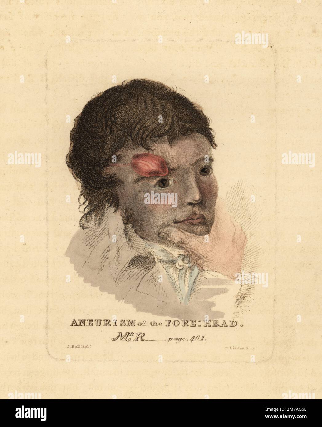 Tumeur anévrystique sur le front d'un jeune homme, 1815. La tumeur avait grandi pendant sept ans avant d'être coupée de M. R---n, un homme de 25 ans. Aneurisme du front, M. R. gravure de coperplate de couleur main par Daniel Lizars après une illustration par John Bell de ses propres principes de chirurgie, comme ils se rapportent aux blessures, aux ulcères et aux fistules, Longman, Hurst, Rees, Orme et Brown, Londres, 1815. Banque D'Images