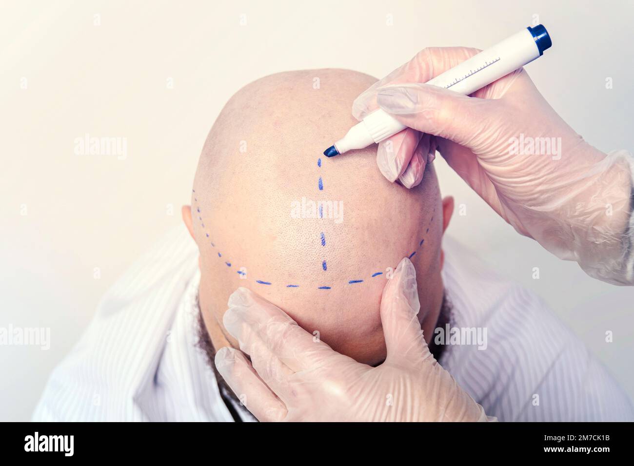 une infirmière dessine des rayures sur le crâne chauve d'un jeune homme pour la chirurgie du cerveau. Le concept de chirurgie et de médecine. le processus de la transplantation de cheveux sur Banque D'Images