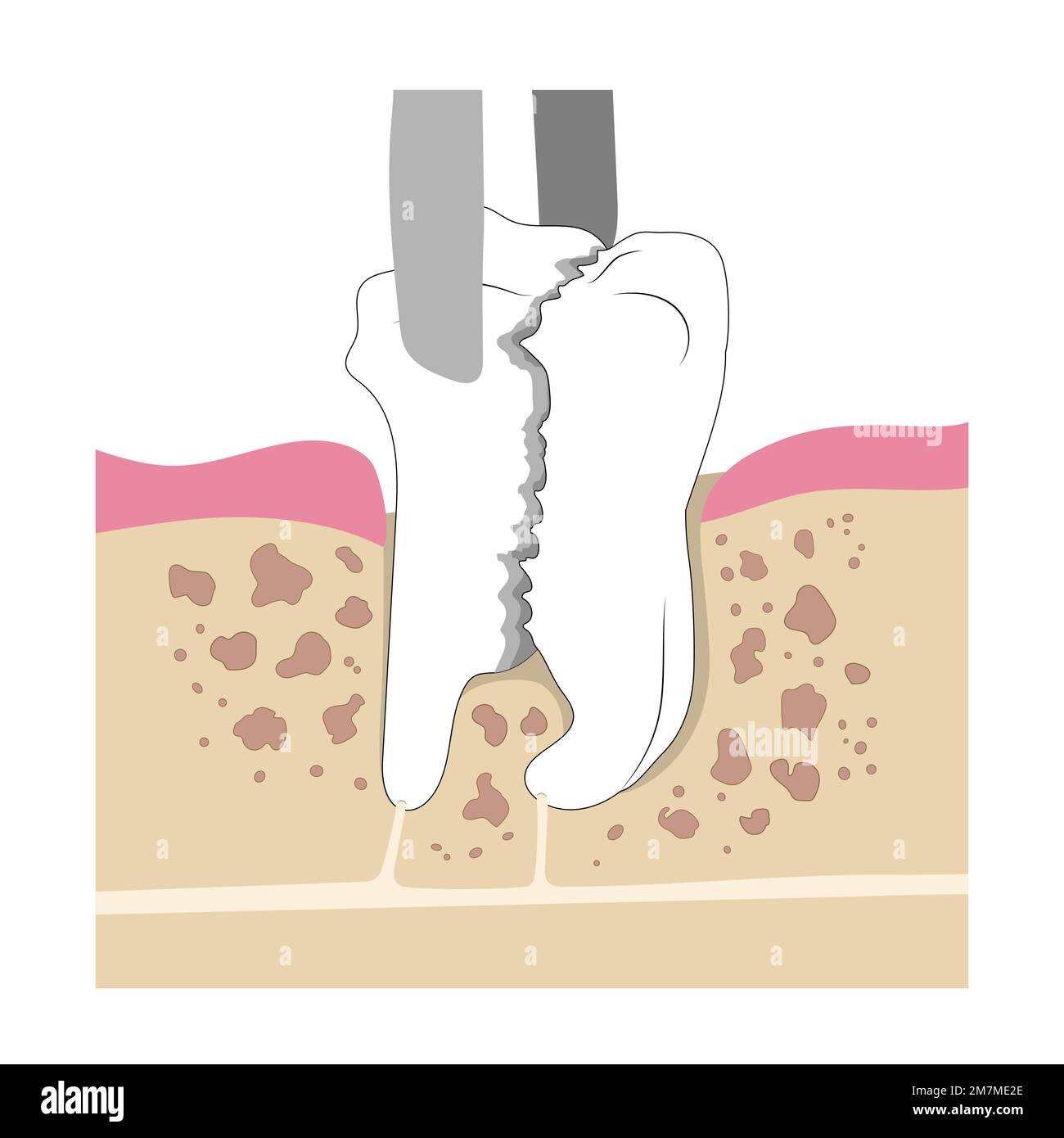 Le retrait de la dent molaire s'est écrasé dans la mâchoire. Extraction chirurgicale d'une dent cassée. Illustration médicale de style plat. Illustration de Vecteur