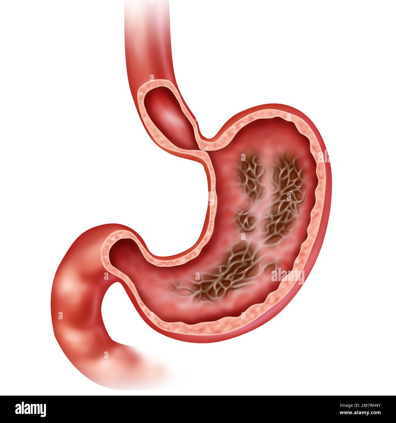 Gastrite maladie de l'estomac comme inflammation de la paroi interne de l'organe digestif avec des symptômes de douleur abdominale entraînant des nausées Banque D'Images