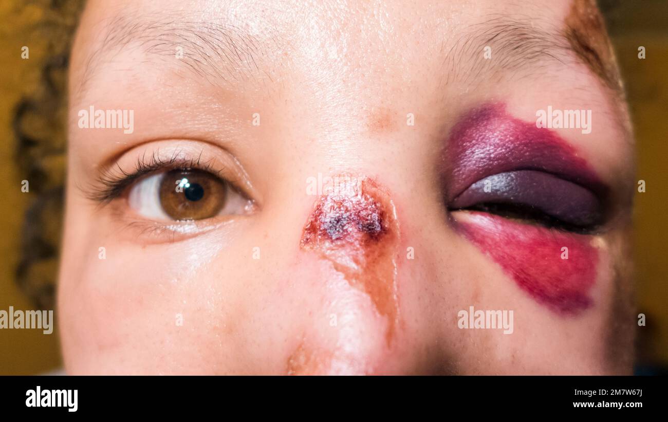 Fille avec oeil noir, Shiner. Gros plan. Grand ecchymose sous les yeux Banque D'Images
