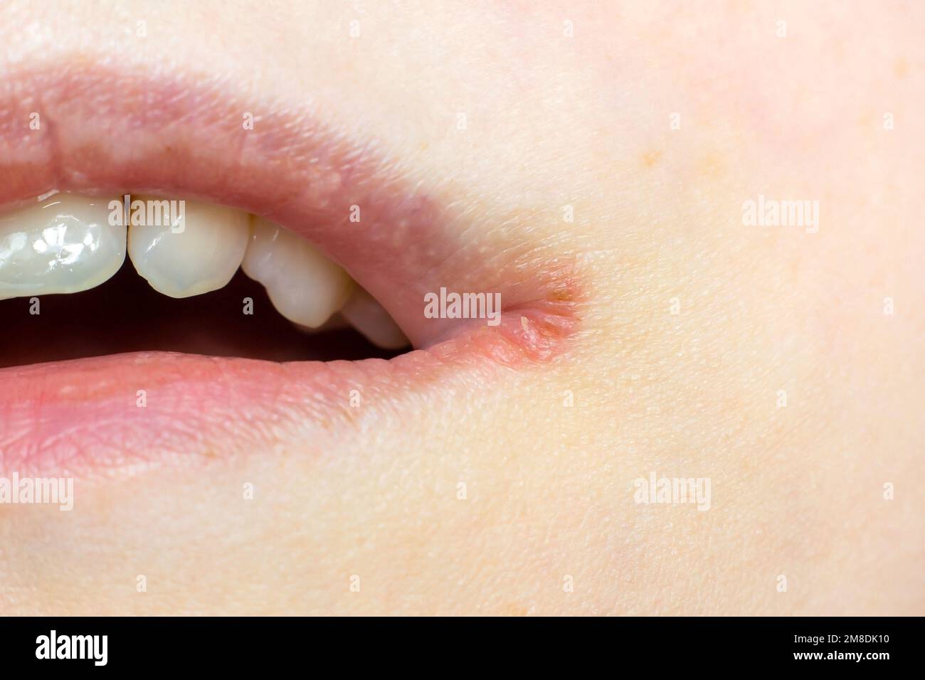Femme lèvres peau avec Herpes labialis virus gros plan. Banque D'Images Femme lèvres peau avec Herpes labialis virus gros plan. Banque D'Images