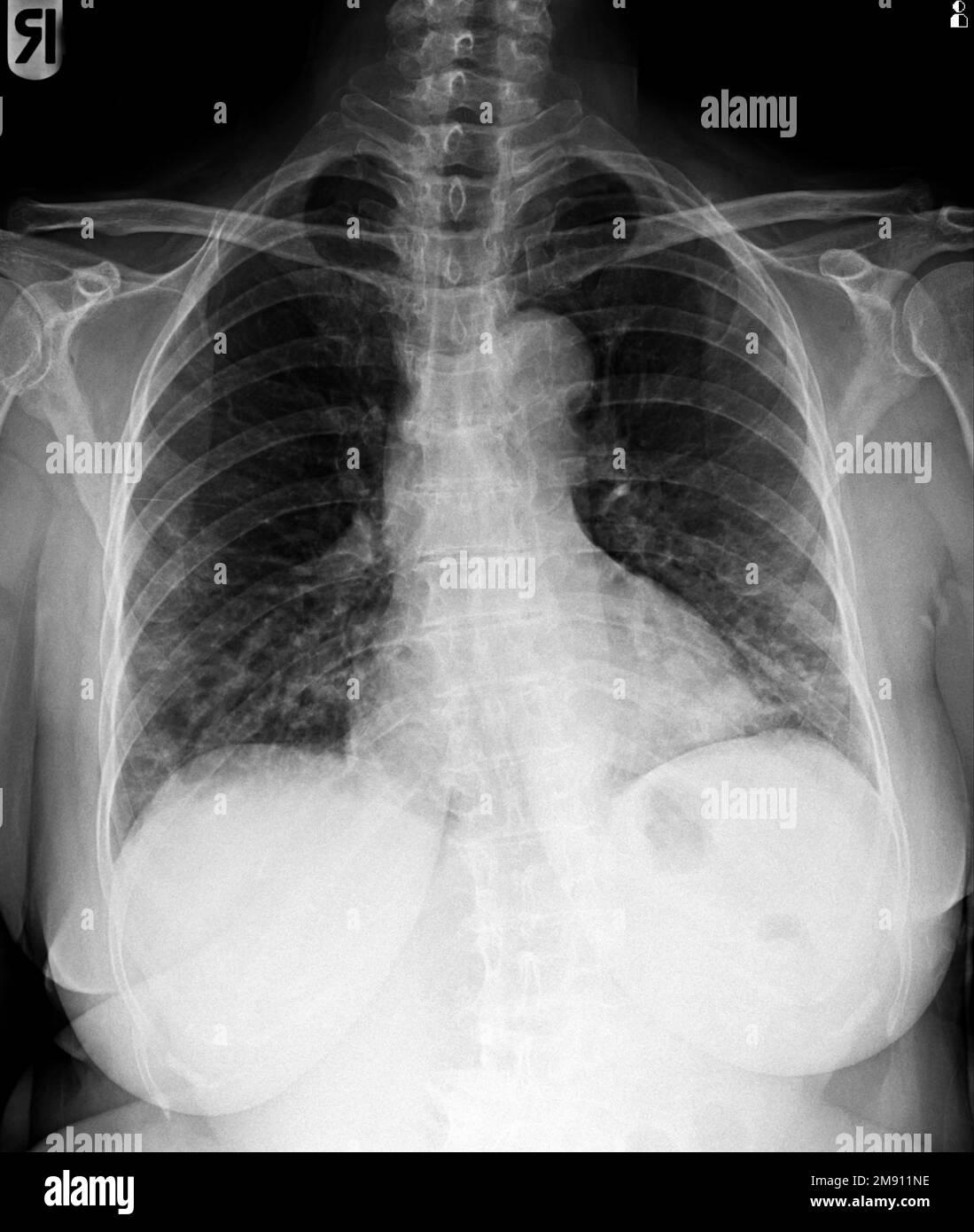 Film radiographie de la poitrine de femme normale . Banque D'Images