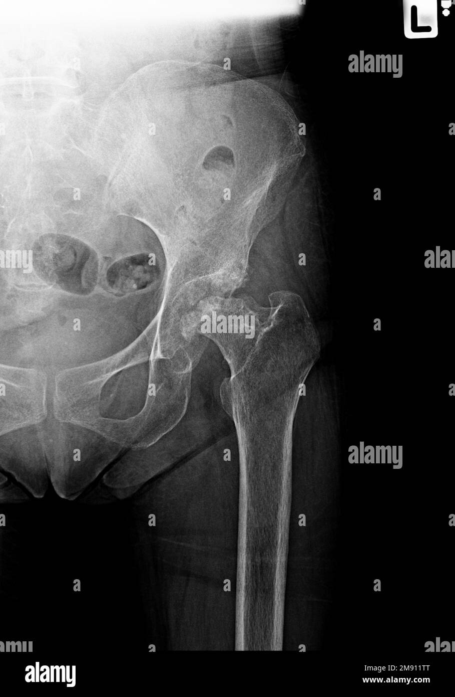 Film X-ray faciture des articulations de la hanche, fracture du cou du fémur Banque D'Images