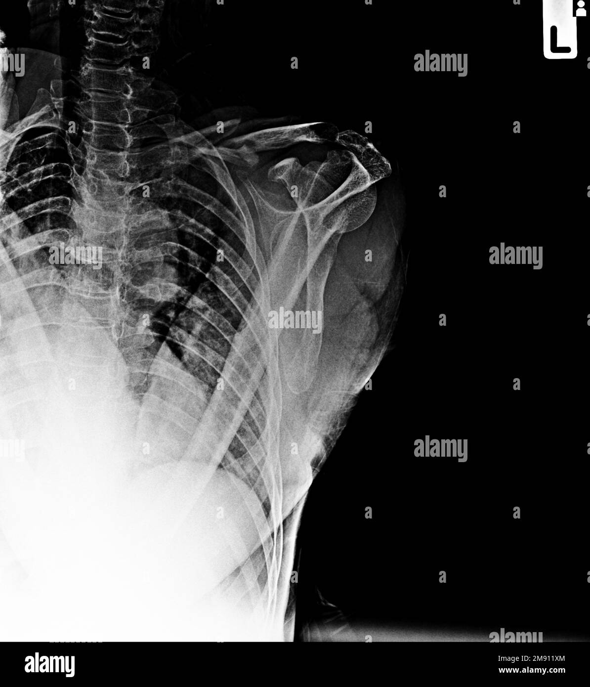 Film X-ray clavicule AP montrent fracture clavicule osseuse Banque D'Images