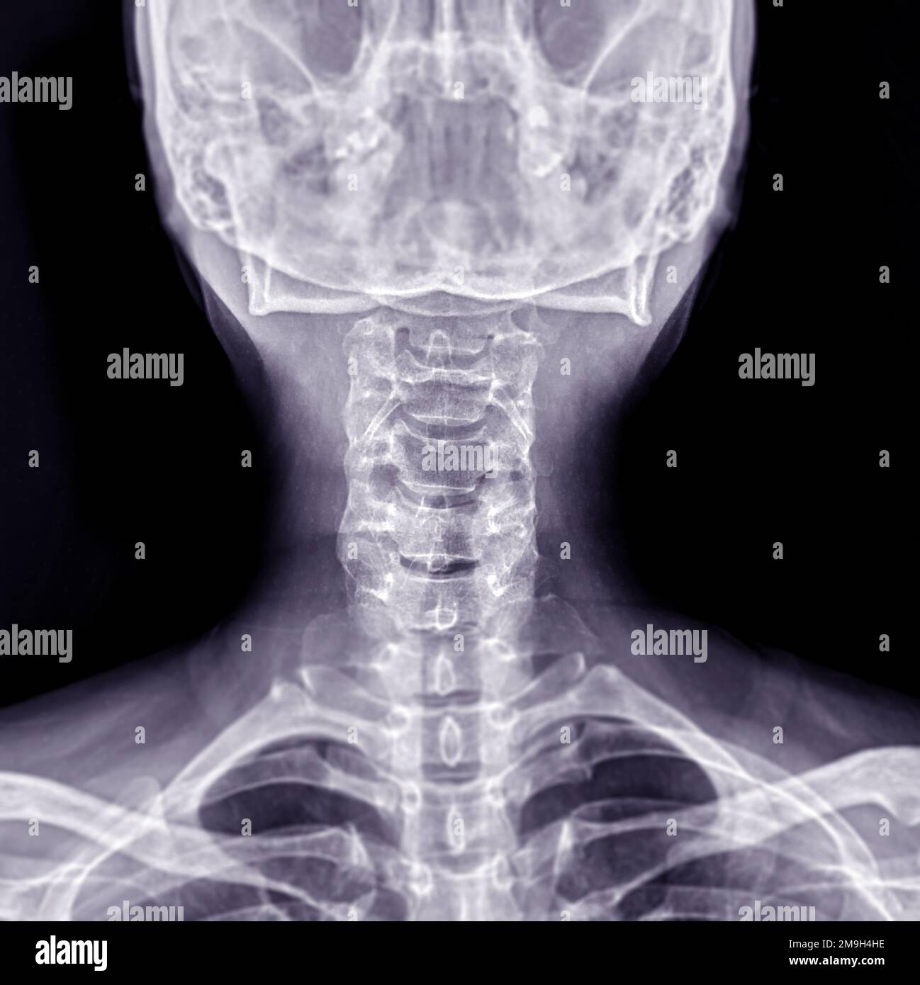 Radiographie du rachis cervical ou radiographie du rachis cervical vue AP pour l'hernie et la spondylose intervertébrales diagnostiques. Banque D'Images