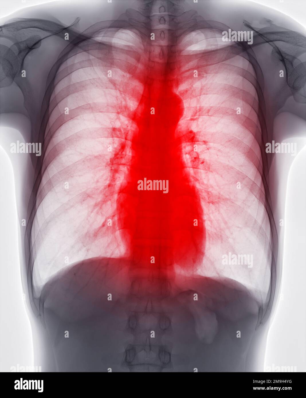 Radiographie thoracique pour le dépistage de la tuberculose, de la tuberculose et du covid-19. Banque D'Images