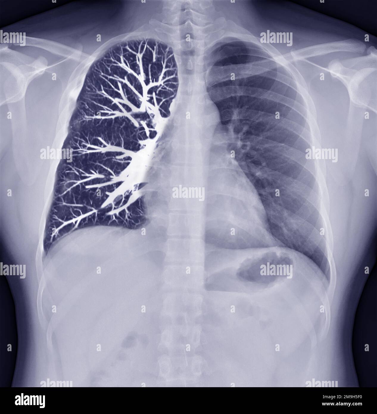 Image de fusion de la radiographie thoracique et de la vue coronale CT du thorax pour l'infection pulmonaire du concept Covid-19. Banque D'Images