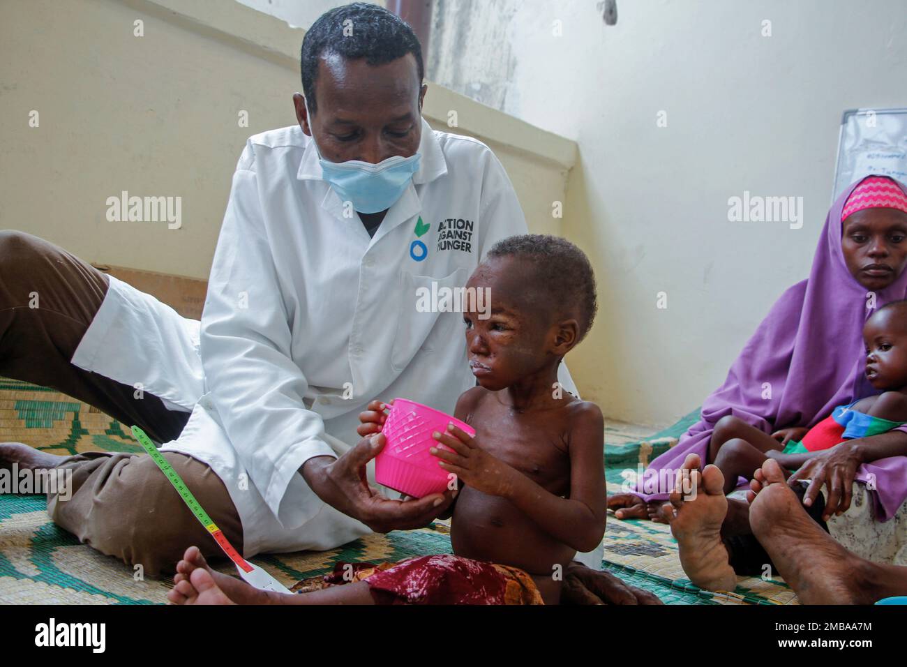 A recently-displaced child showing symptoms of Kwashiorkor, a severe 