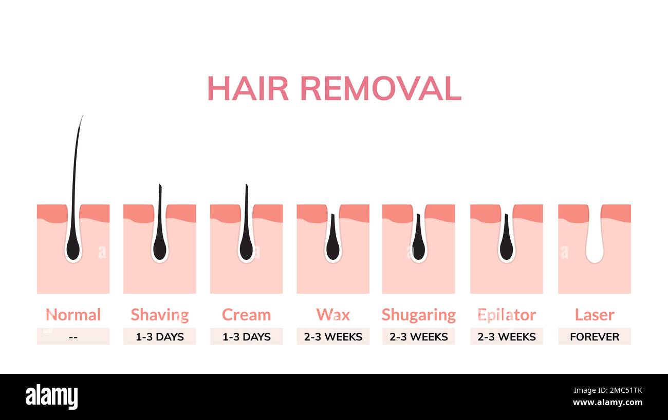 Épilation laser traitement peau vecteur illustration bikini cosmétique