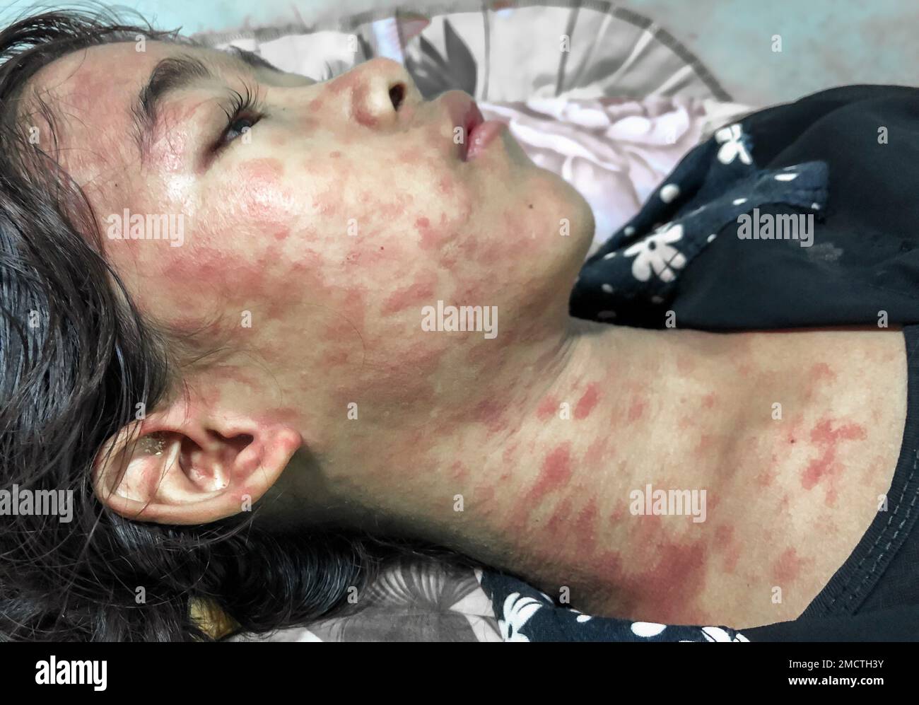 Éruption de Chikungunya sur le visage et le cou de l'enfant asiatique. Lésions cutanées macolapulaires généralisées. Banque D'Images