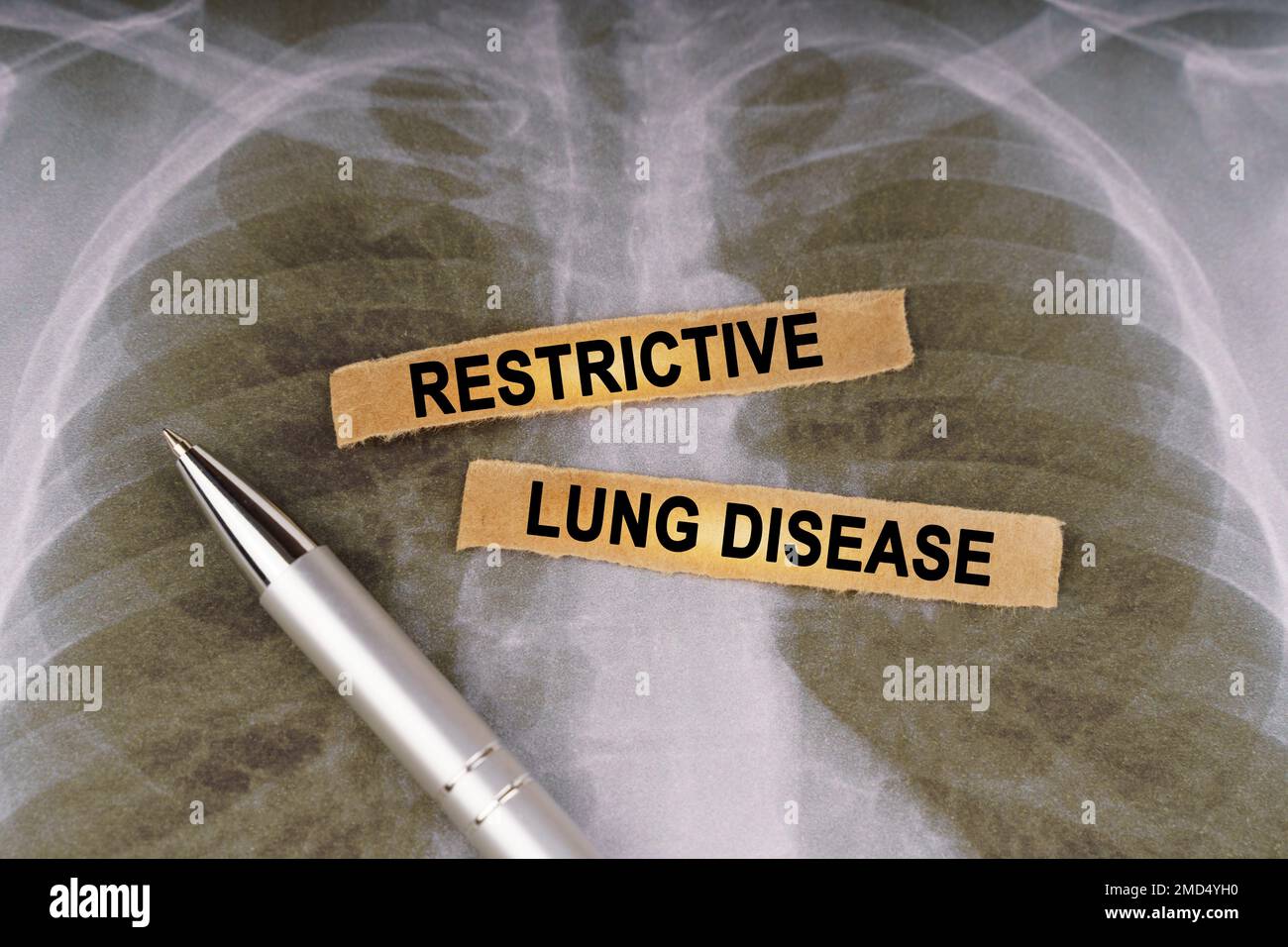 Concept médical. Sur une radiographie thoracique humaine, un stylo et des bandes de papier étiquetés - maladie pulmonaire restrictive Banque D'Images