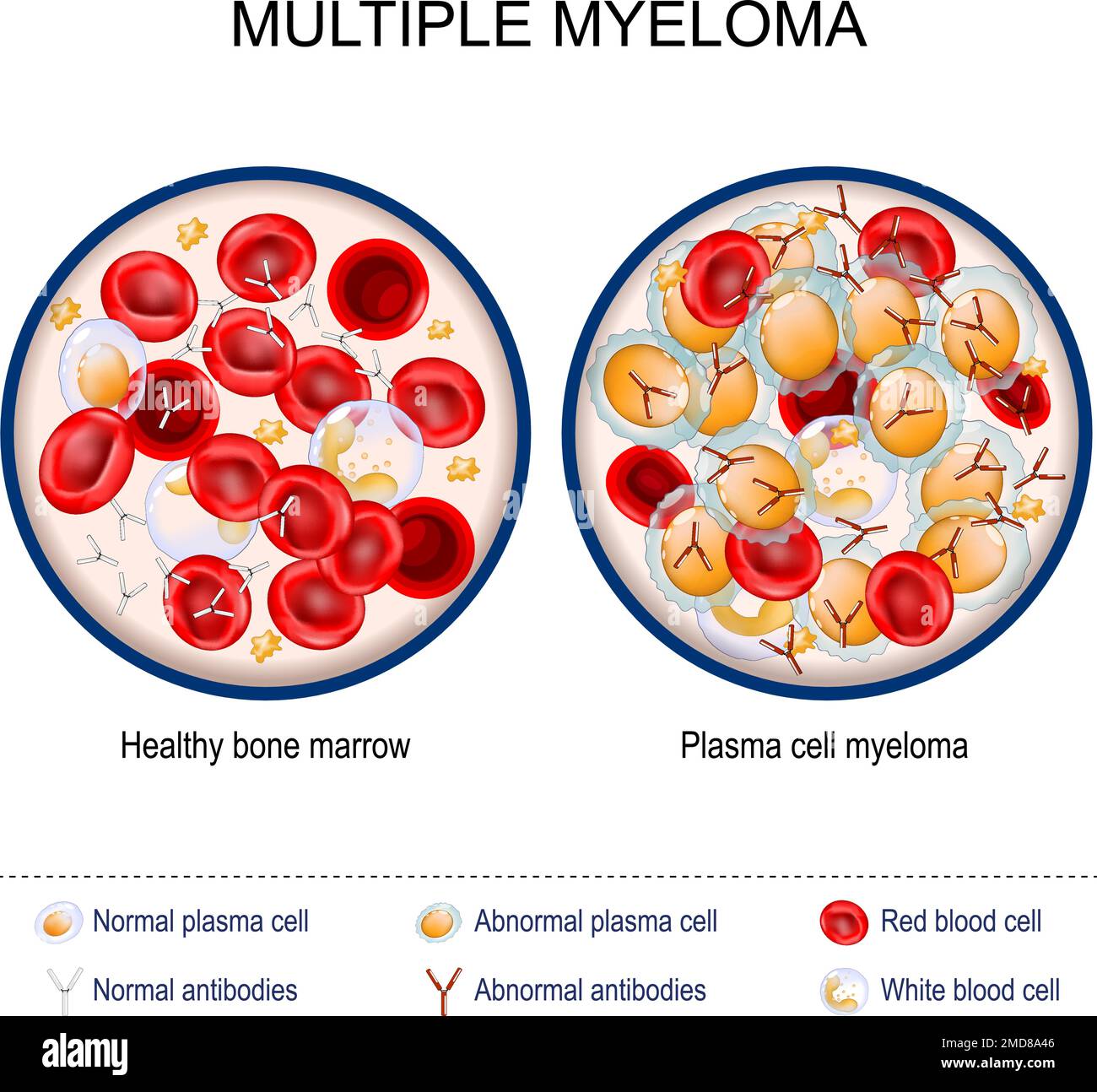 Myélome multiple. Gros plan de la moelle osseuse saine et du myélome à cellules plasmatiques. Globules rouges et blancs, anticorps normaux et anormaux. cancer du plasma Illustration de Vecteur