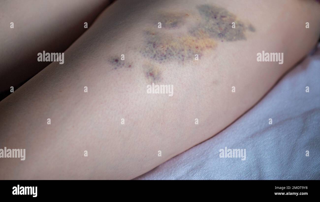 Ecchymoses sur la peau de la jambe du patient après des injections intramusculaires du médicament. Traitement des joints et des ecchymoses après injections, gros plan Banque D'Images