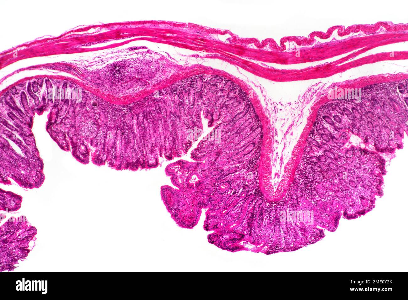 Schistosomiase de l'intestin humain, photomicrographe à fond clair Banque D'Images