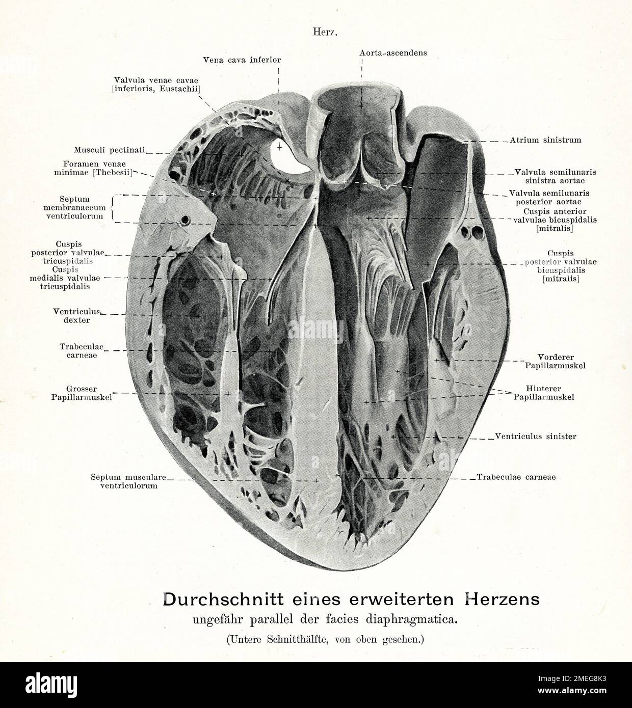 Illustration ancienne de l'anatomie, coeur musculature: Section parallèle au faciès diaphragmatique avec un coeur dilaté, descriptions anatomiques allemandes Banque D'Images