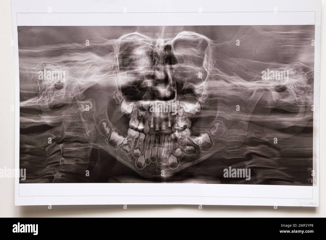 Une radiographie panoramique montre plusieurs dents incrustées et affectées sur la mâchoire supérieure et inférieure des dents des enfants Banque D'Images