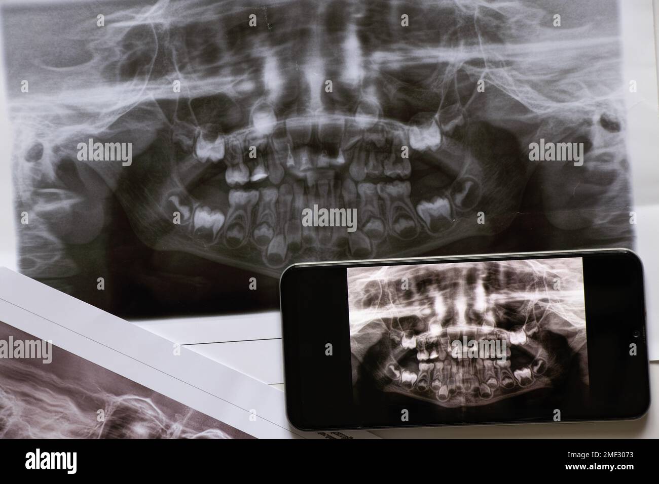 La prise de vue panoramique montre plusieurs dents incrustées et impactées sur la mâchoire supérieure et inférieure des dents des enfants sur les écrans du téléphone, application mobile Banque D'Images