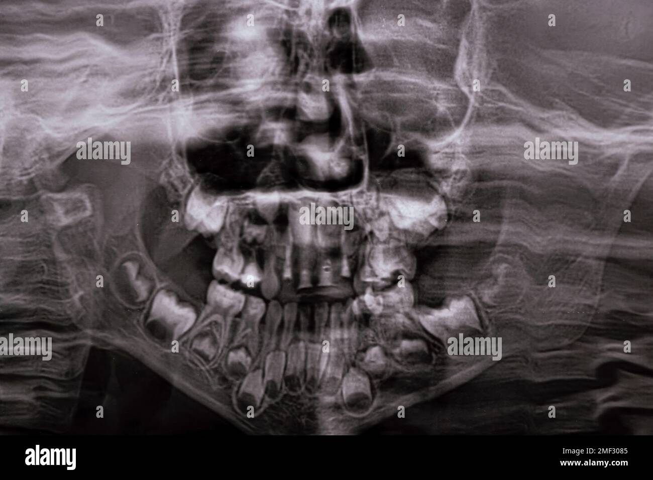 Une radiographie panoramique montre plusieurs dents incrustées et affectées sur la mâchoire supérieure et inférieure des dents des enfants Banque D'Images