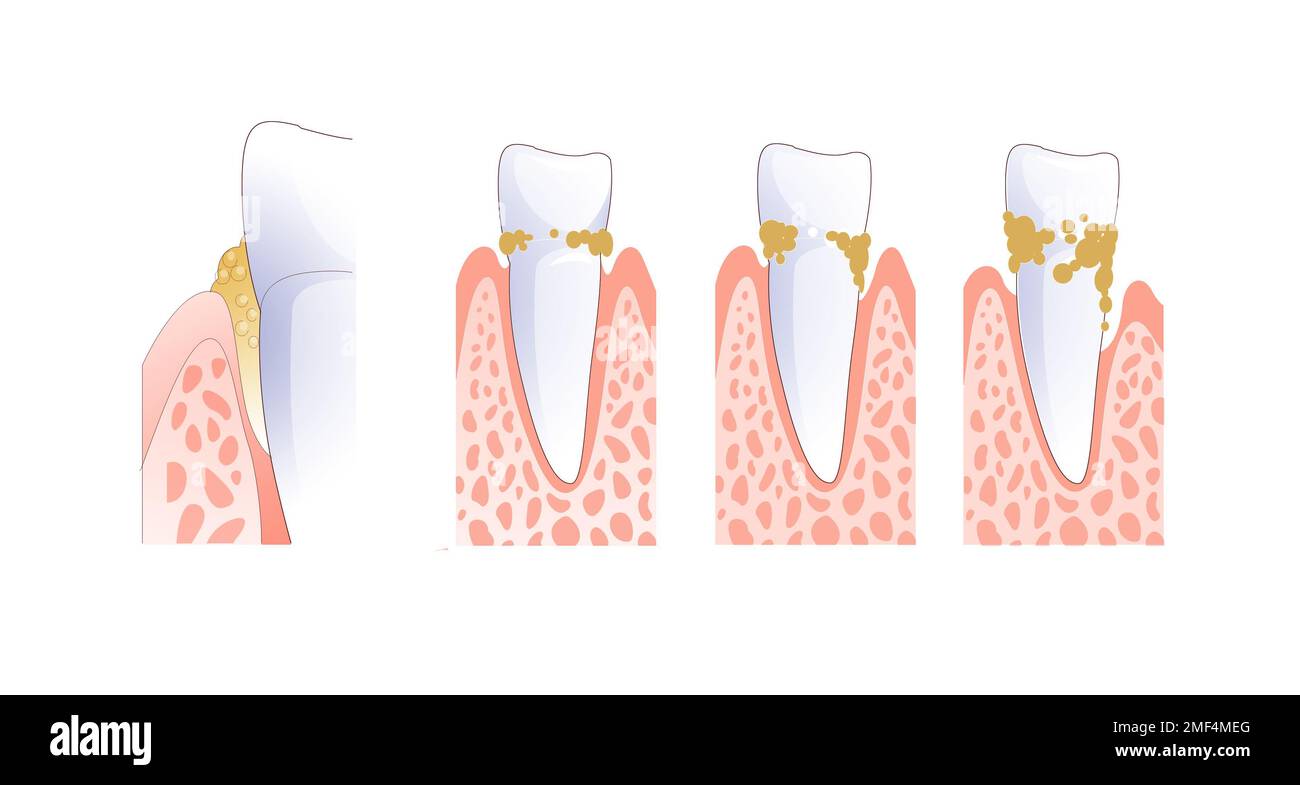 Illustration numérique des dents et des gencives avec du tartre. Diverses phases de l'augmentation de l'état dentaire. Banque D'Images