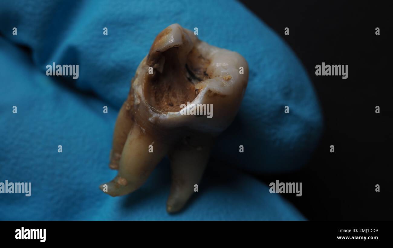 Carie dentaire et main de dentiste avec gant et fond noir. Photo macro d'une dent décalées jusqu'à la racine après l'extraction du dentiste. Anatomie réelle des dents Banque D'Images